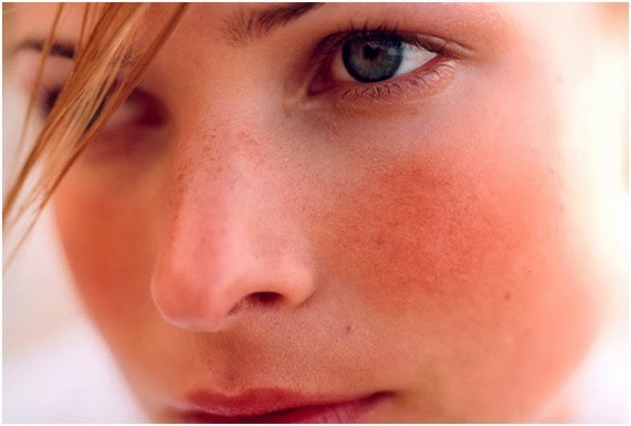piel rosácea